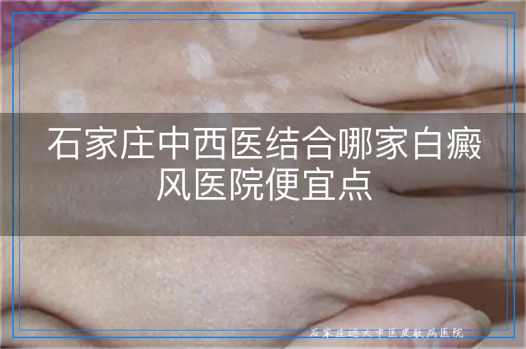 石家庄中西医结合哪家白癜风医院便宜点