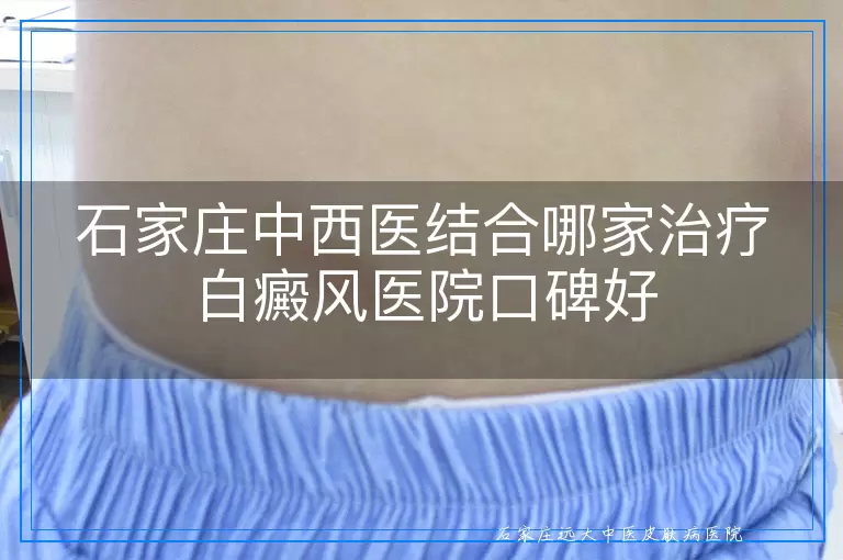 石家庄中西医结合哪家治疗白癜风医院口碑好