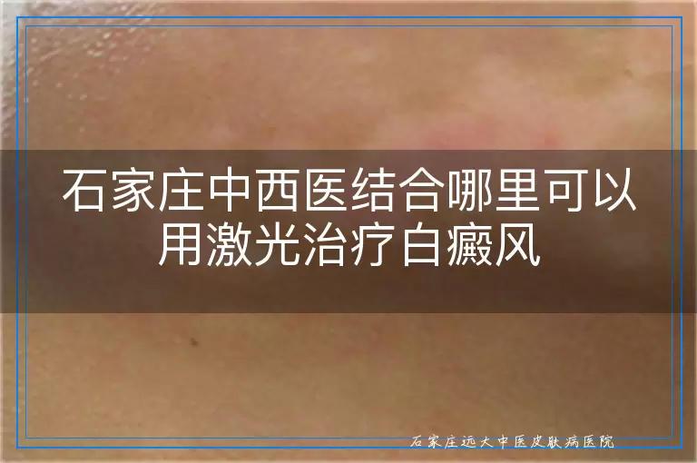 石家庄中西医结合哪里可以用激光治疗白癜风