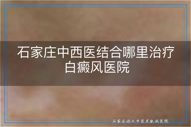 石家庄中西医结合哪里治疗白癜风医院