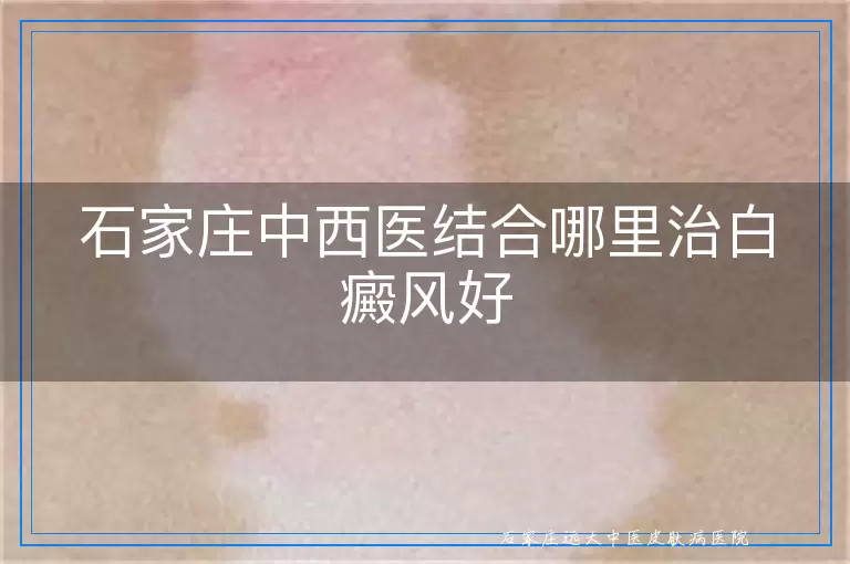 石家庄中西医结合哪里治白癜风好