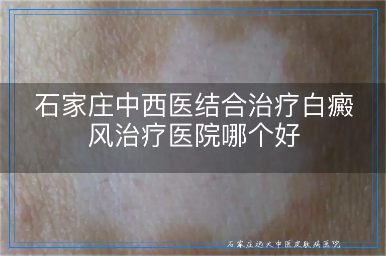石家庄中西医结合治疗白癜风治疗医院哪个好