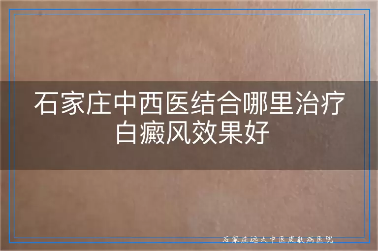 石家庄中西医结合哪里治疗白癜风效果好