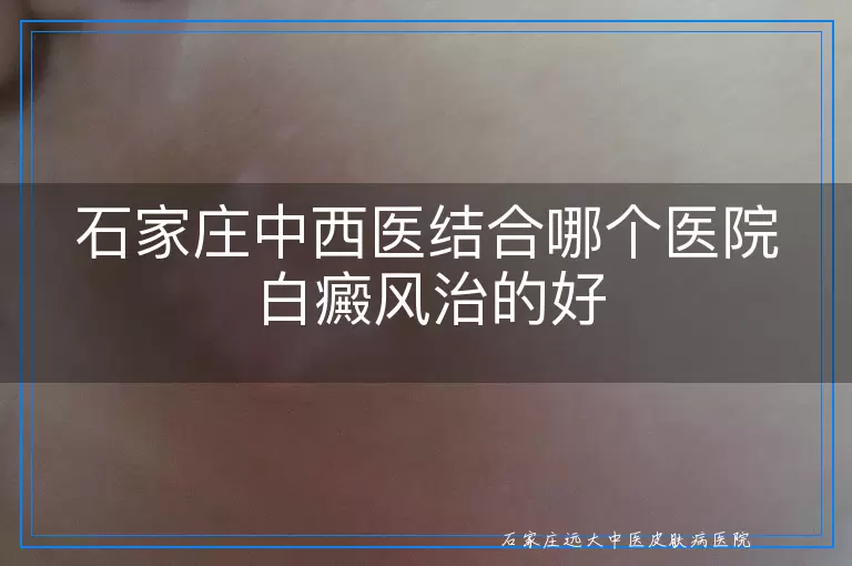 石家庄中西医结合哪个医院白癜风治的好