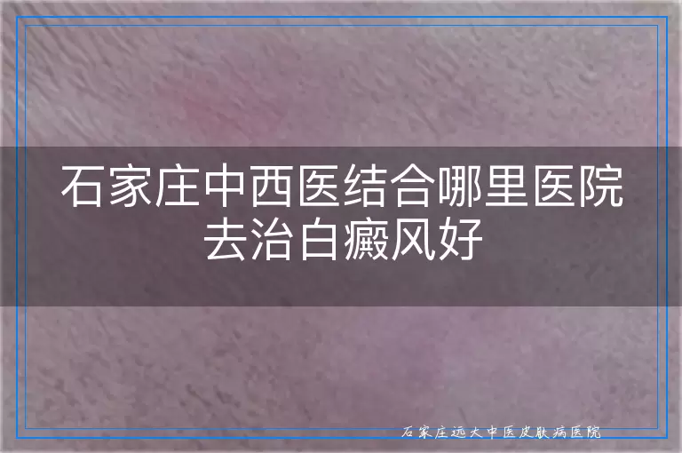 石家庄中西医结合哪里医院去治白癜风好