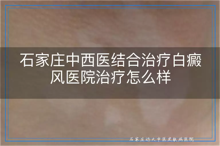 石家庄中西医结合治疗白癜风医院治疗怎么样