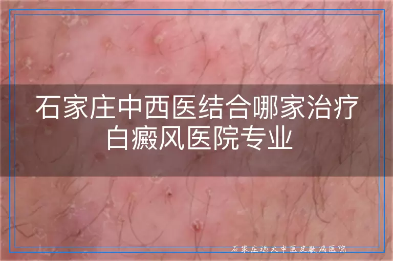 石家庄中西医结合哪家治疗白癜风医院专业