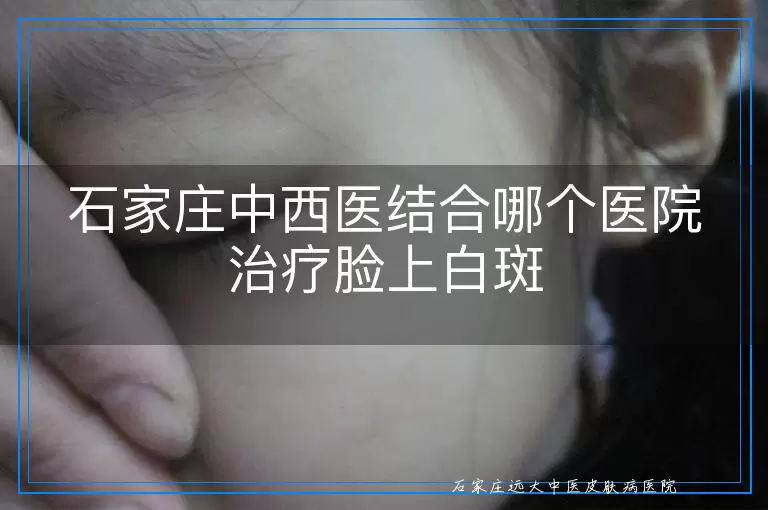 石家庄中西医结合哪个医院治疗脸上白斑
