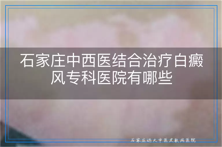 石家庄中西医结合治疗白癜风专科医院有哪些