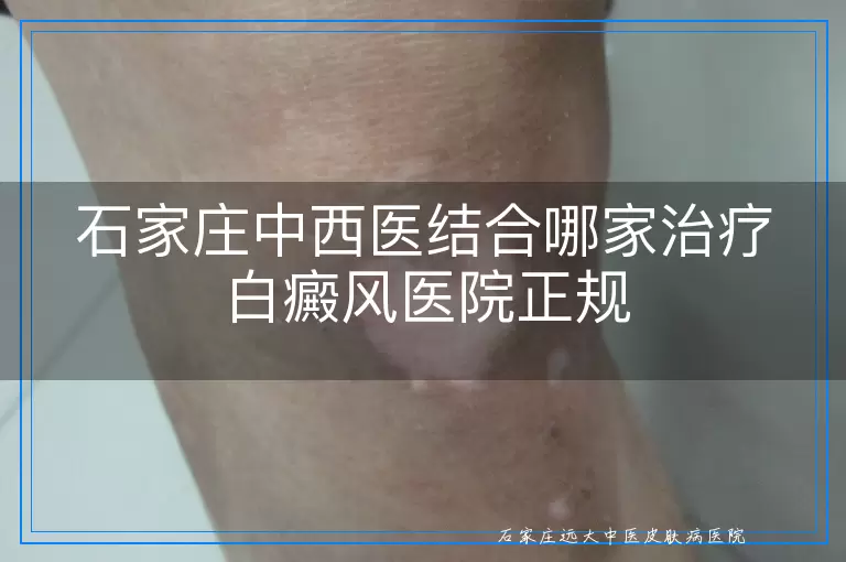 石家庄中西医结合哪家治疗白癜风医院正规