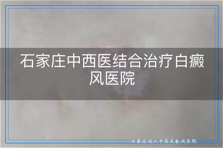 石家庄中西医结合治疗白癜风医院