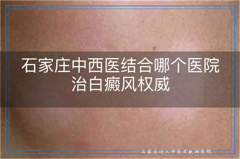 石家庄中西医结合哪个医院治白癜风权威