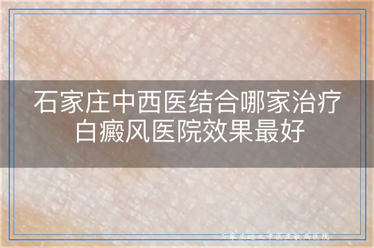 石家庄中西医结合哪家治疗白癜风医院效果最好