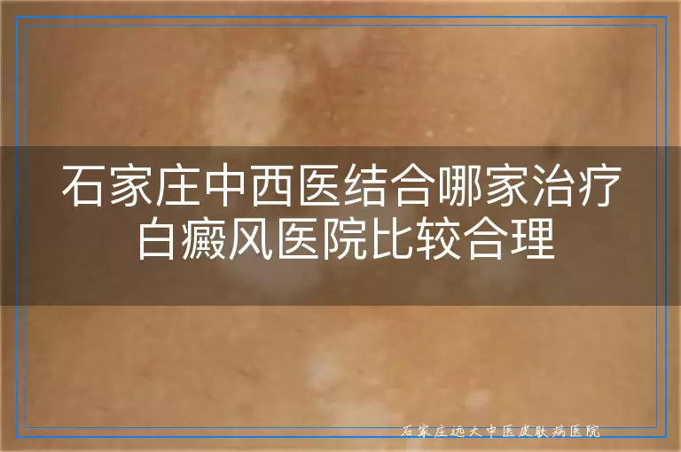 石家庄中西医结合哪家治疗白癜风医院比较合理