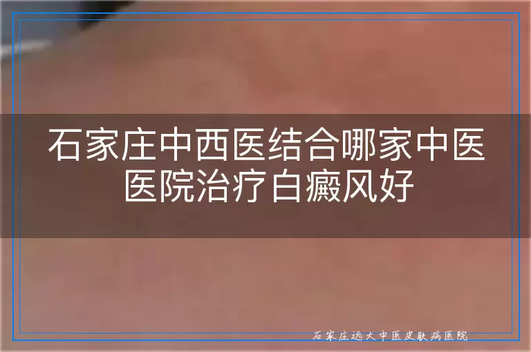 石家庄中西医结合哪家中医医院治疗白癜风好