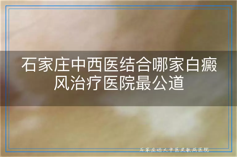 石家庄中西医结合哪家白癜风治疗医院最公道