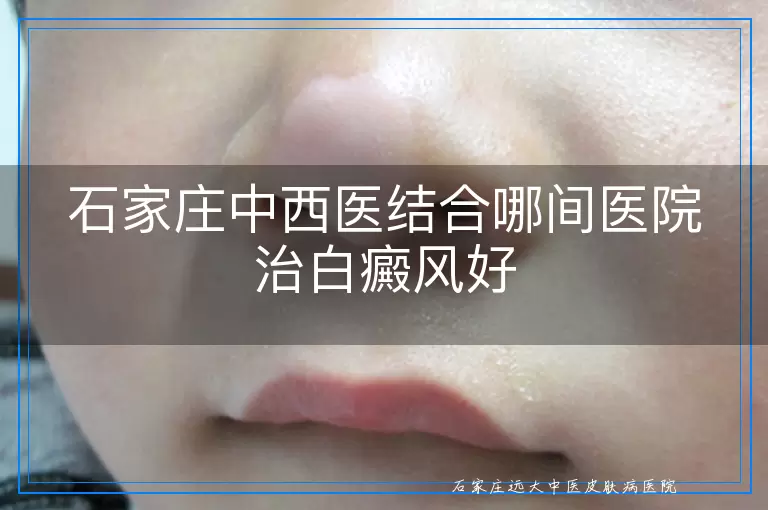 石家庄中西医结合哪间医院治白癜风好