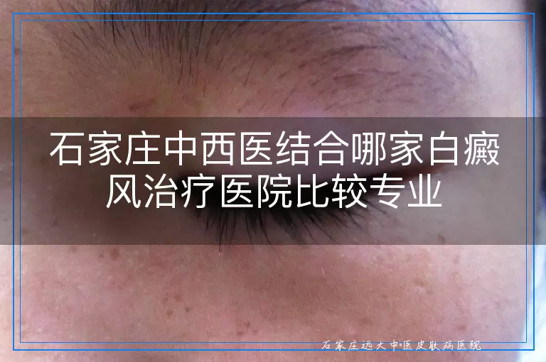 石家庄中西医结合哪家白癜风治疗医院比较专业