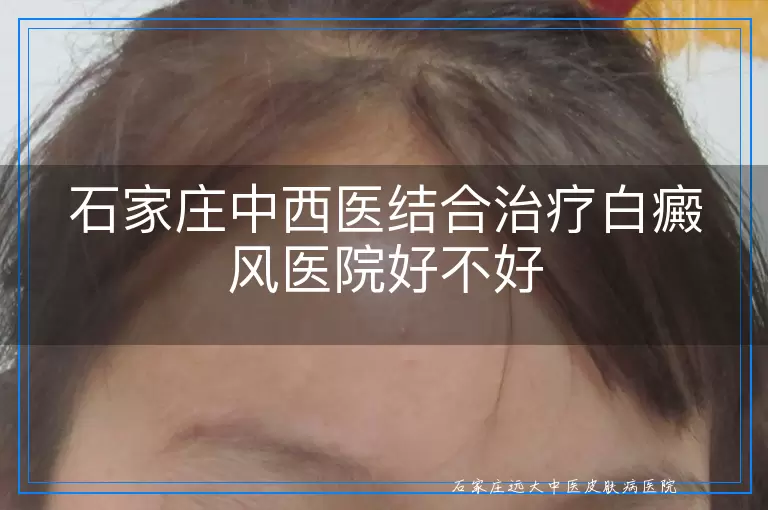 石家庄中西医结合治疗白癜风医院好不好