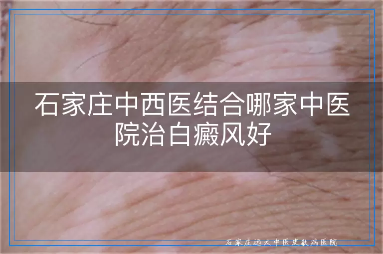 石家庄中西医结合哪家中医院治白癜风好