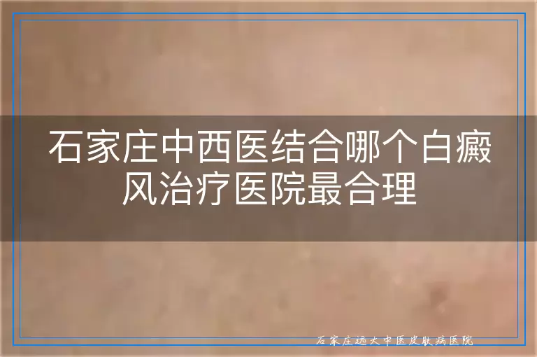 石家庄中西医结合哪个白癜风治疗医院最合理