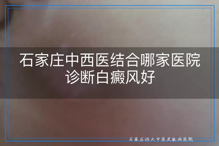 石家庄中西医结合哪家医院诊断白癜风好