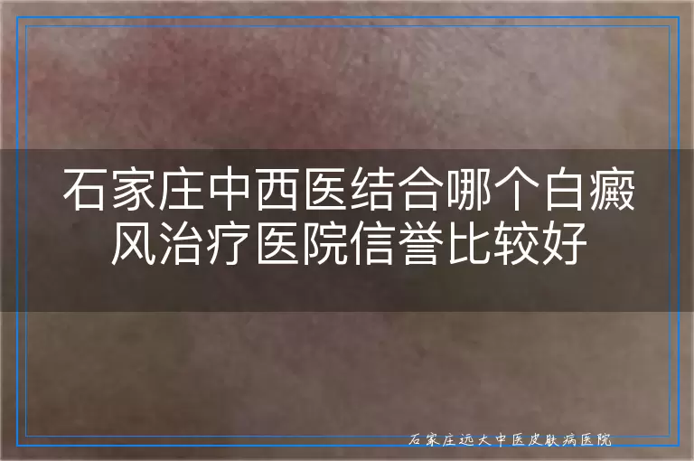 石家庄中西医结合哪个白癜风治疗医院信誉比较好