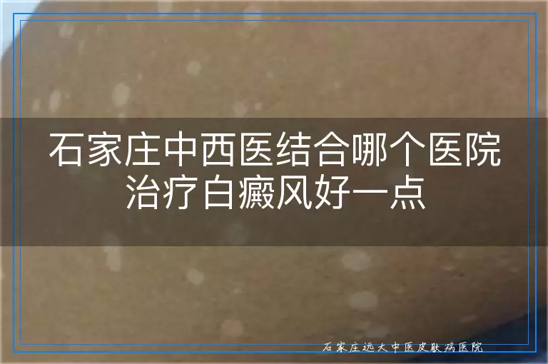 石家庄中西医结合哪个医院治疗白癜风好一点