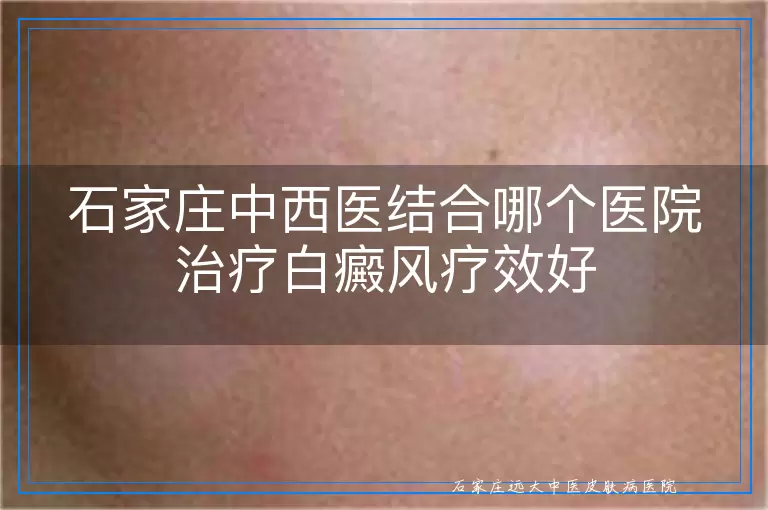 石家庄中西医结合哪个医院治疗白癜风疗效好