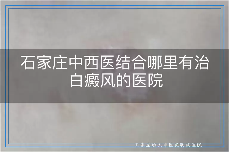 石家庄中西医结合哪里有治白癜风的医院