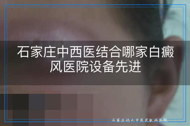 石家庄中西医结合哪家白癜风医院设备先进