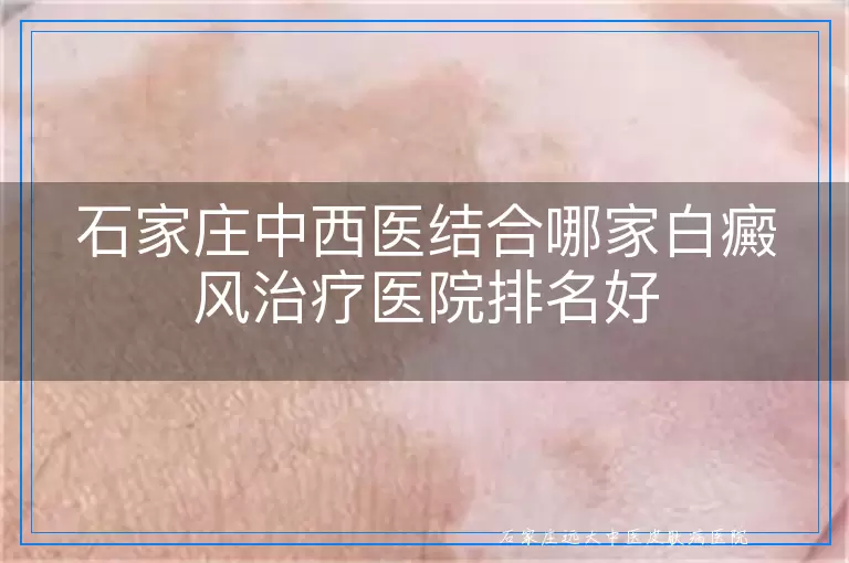 石家庄中西医结合哪家白癜风治疗医院排名好