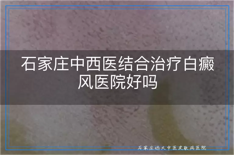 石家庄中西医结合治疗白癜风医院好吗