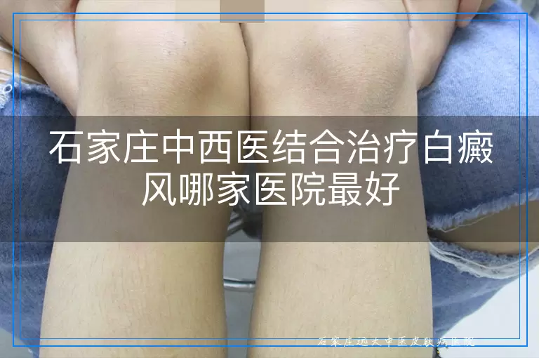 石家庄中西医结合治疗白癜风哪家医院最好