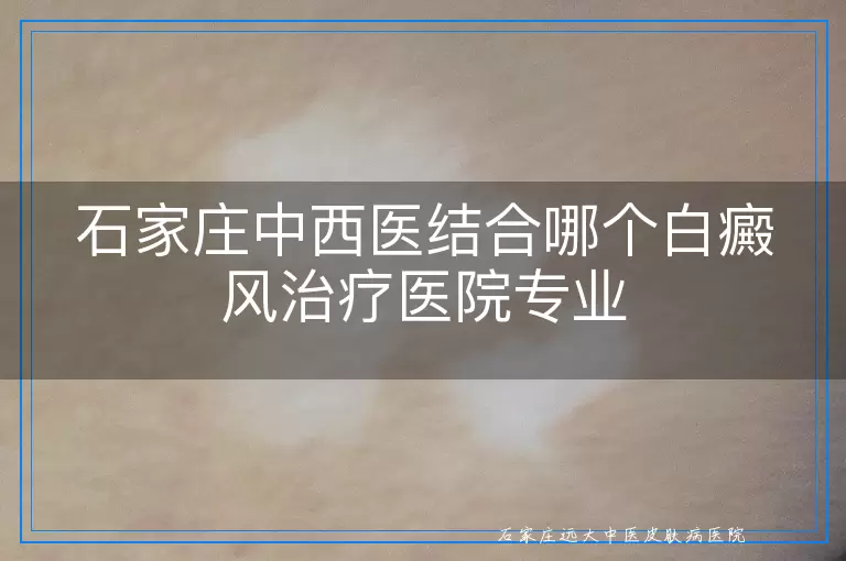 石家庄中西医结合哪个白癜风治疗医院专业