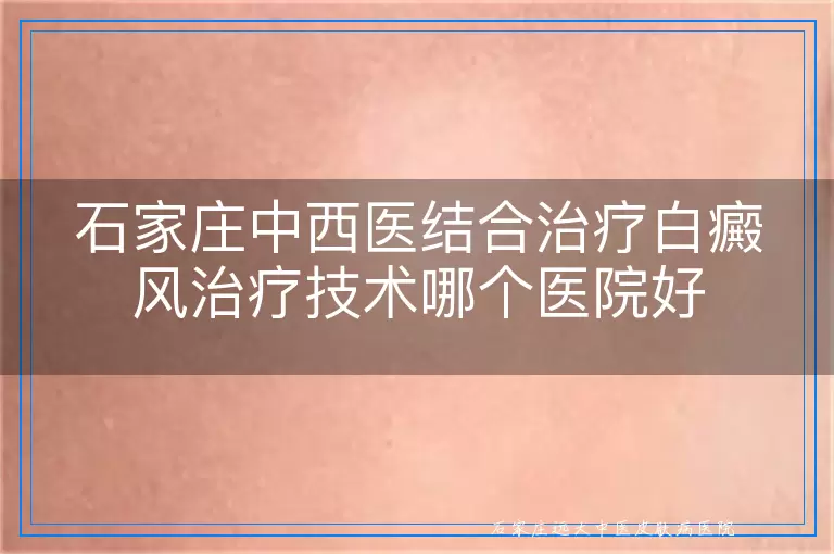 石家庄中西医结合治疗白癜风治疗技术哪个医院好