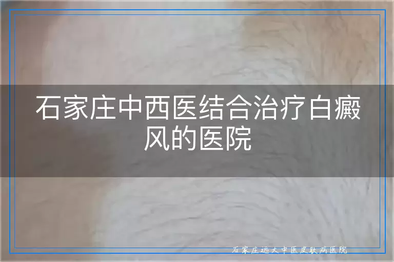 石家庄中西医结合治疗白癜风的医院