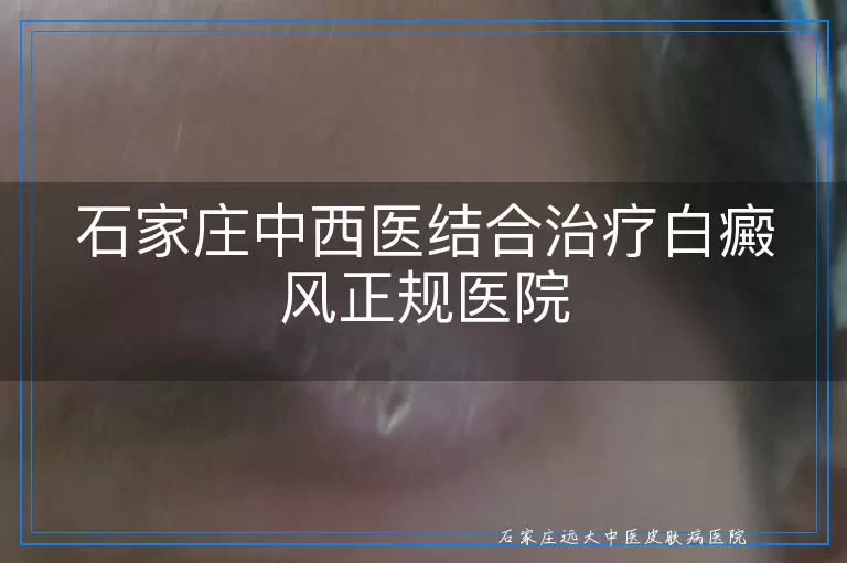 石家庄中西医结合治疗白癜风正规医院