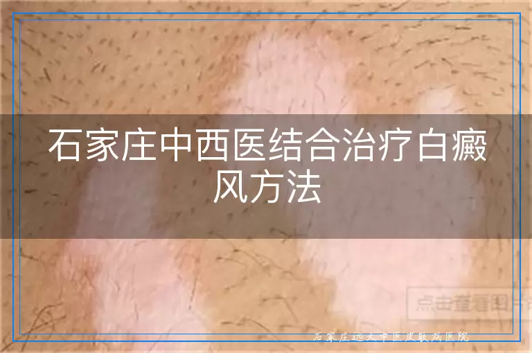 石家庄中西医结合治疗白癜风方法