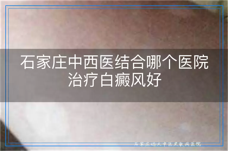 石家庄中西医结合哪个医院治疗白癜风好
