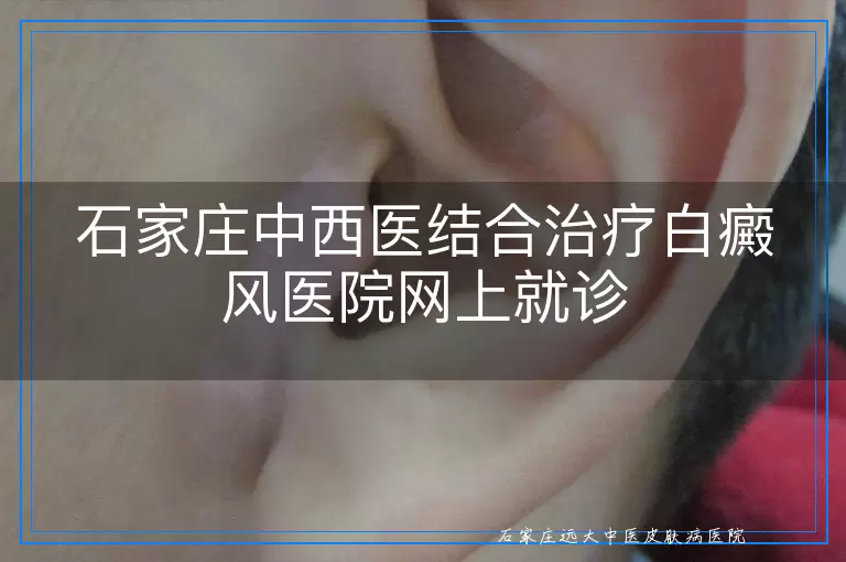 石家庄中西医结合治疗白癜风医院网上就诊