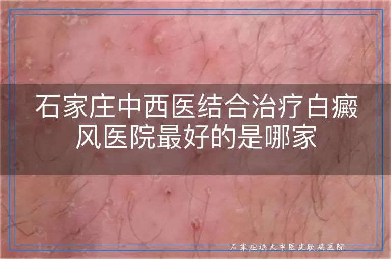 石家庄中西医结合治疗白癜风医院最好的是哪家