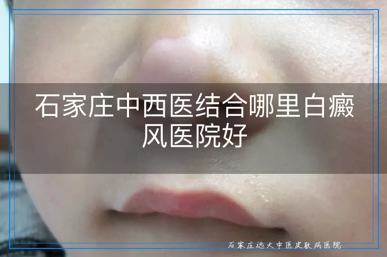 石家庄中西医结合哪里白癜风医院好