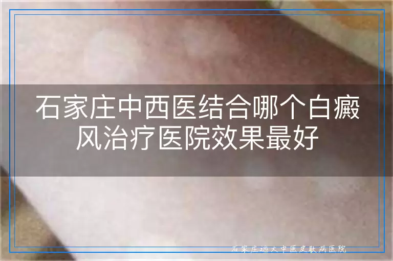 石家庄中西医结合哪个白癜风治疗医院效果最好