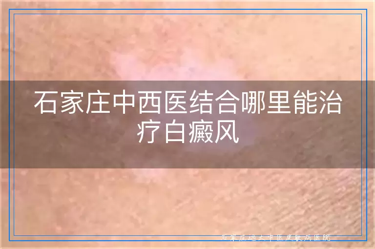 石家庄中西医结合哪里能治疗白癜风