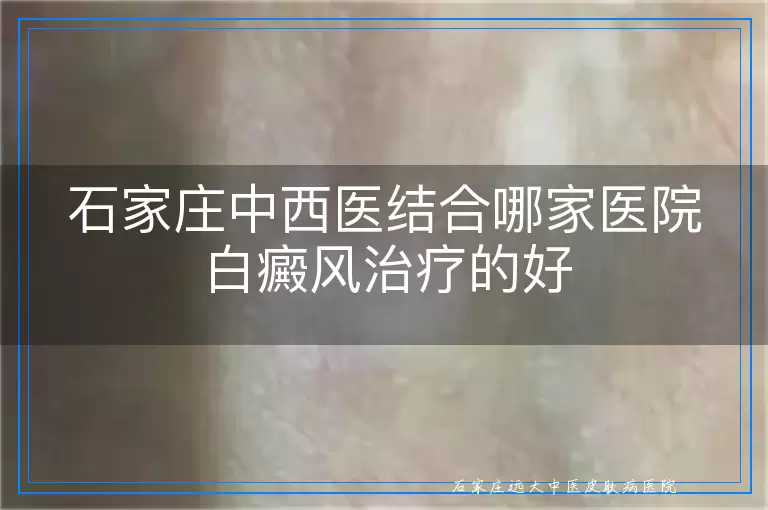 石家庄中西医结合哪家医院白癜风治疗的好