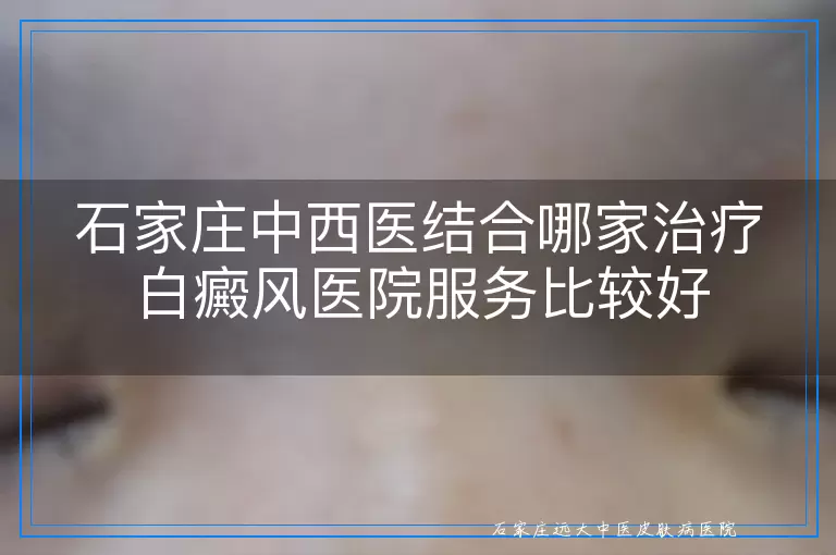 石家庄中西医结合哪家治疗白癜风医院服务比较好