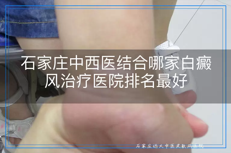 石家庄中西医结合哪家白癜风治疗医院排名最好