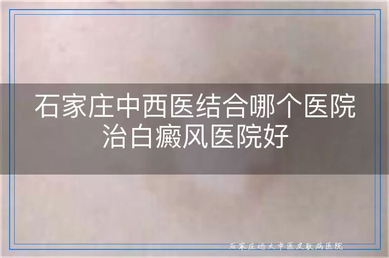 石家庄中西医结合哪个医院治白癜风医院好