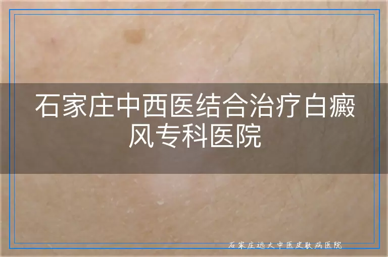 石家庄中西医结合治疗白癜风专科医院
